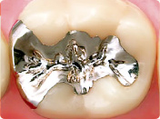 一般歯科治療 詰め物 パラ