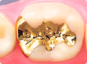 一般歯科治療 詰め物 ゴールド