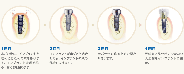 上村歯科・インプラント治療のイメージ